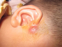 先天性耳前瘺管