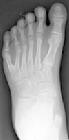 （圖）後軸多趾畸形的左腳