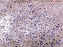 類肺炎性胸腔積液