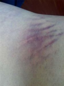 排病反應 排病反應