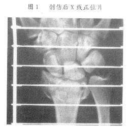 尺橈骨幹雙骨折