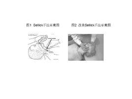 改良Sellick手法 改良Sellick手法