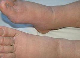 踝部凹陷性水腫 踝部凹陷性水腫