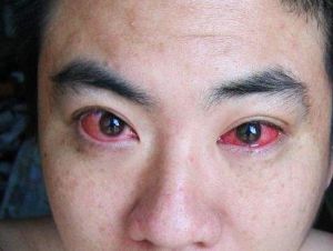 紅眼病