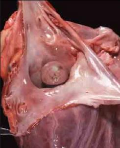 心臟內粘液瘤 心臟內粘液瘤