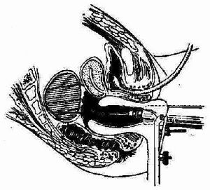 盆腔膿腫 盆腔膿腫