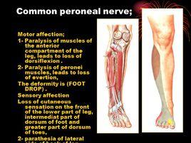 腓總神經麻痹 腓總神經麻痹