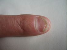 灰指甲治療方法