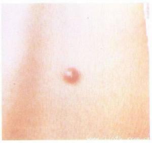 睫狀體神經纖維瘤