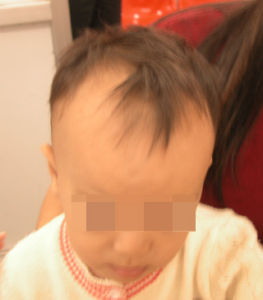 嬰幼兒維生素D缺乏性佝僂病 嬰幼兒維生素D缺乏性佝僂病