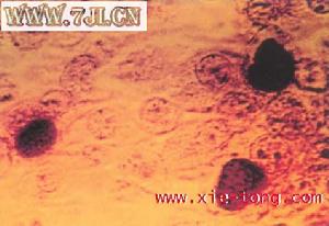 女性沙眼衣原體感染