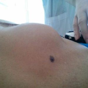 腹部包塊 腹部包塊