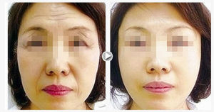 電波拉皮除皺手術前後對比圖