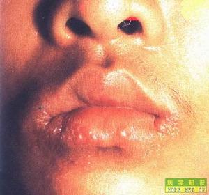 口腔單純性皰疹
