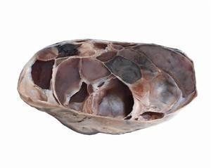 卵巢惡性腹膜間皮瘤 卵巢惡性腹膜間皮瘤