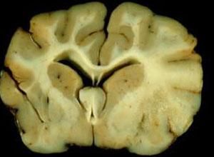 腦白質變性 腦白質變性