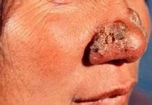 皮膚肉芽腫 皮膚肉芽腫