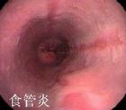 反流性食道炎