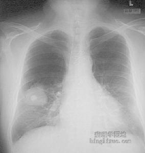 免疫缺陷性肺炎