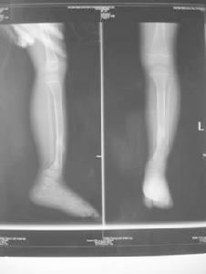 先天性脛骨假關節