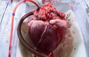 心臟移植手術