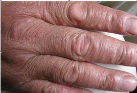 剝脫性交之綜合症 剝脫性交之綜合症