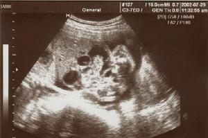 先天性十二指腸閉鎖