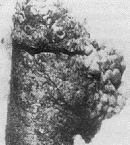 脫屑性間質肺炎