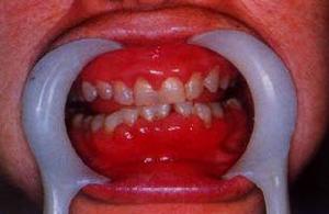 肥大性齦炎 肥大性齦炎