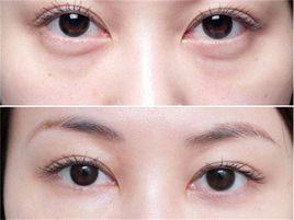 眼袋吸脂 眼袋吸脂