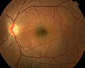 視網膜變性
