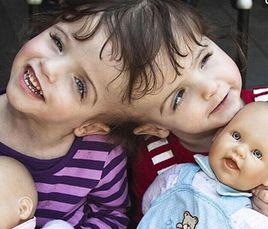 加拿大連體姐妹 加拿大連體姐妹