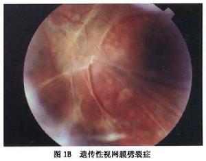 脈絡膜脫離型視網膜脫離