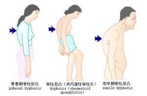 脊柱後凸 脊柱後凸