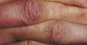 唐納德·昂格爾60多年來每天不斷敲打左手指關節，並跟右手對照，研究會否導致關節炎