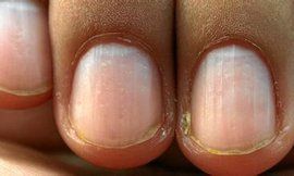 泰利氏指甲 泰利氏指甲