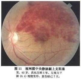 視網膜分支靜脈阻塞