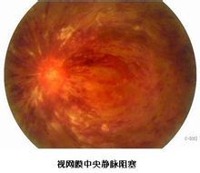視網膜中央靜脈阻塞性 視網膜中央靜脈阻塞性