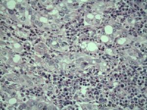 上頜竇惡性腫瘤