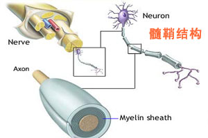 多灶性運動神經病
