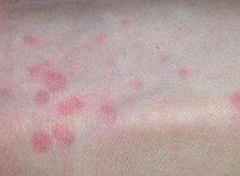 紅色或紫色,稍高起的丘疹或結節 紅色或紫色,稍高起的丘疹或結節