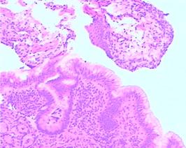 嬰幼兒胃食管反流