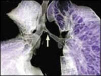 血行播散型肺結核