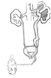 腎及輸尿管重複畸形