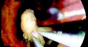 奇聞---鼻腔內孵蠅蛆