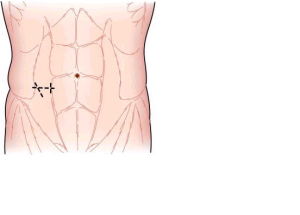 麥氏切口 麥氏切口