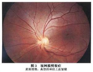 先天性視網膜劈裂症