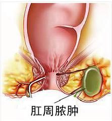 肛門直腸周圍膿腫 肛門直腸周圍膿腫