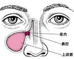 慢性額竇炎 慢性額竇炎