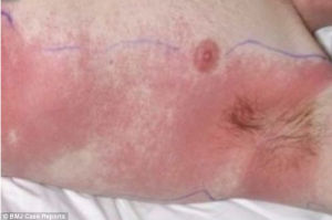 英國一名男性在服用青黴素後過敏致腋窩、腹股溝和臀部出現大面積紅疹